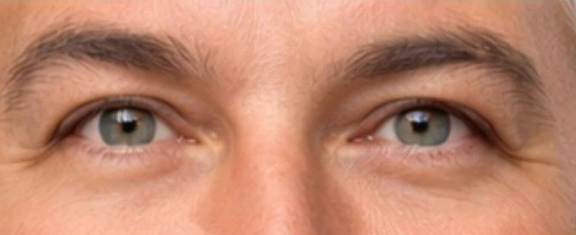 Upper Eye Lid Surgery